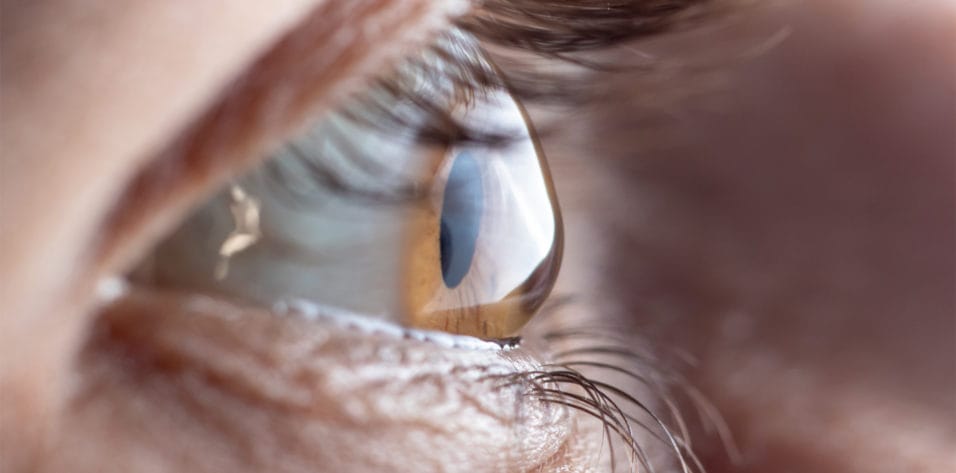 Care for Keratoconus and Corneal ectasias